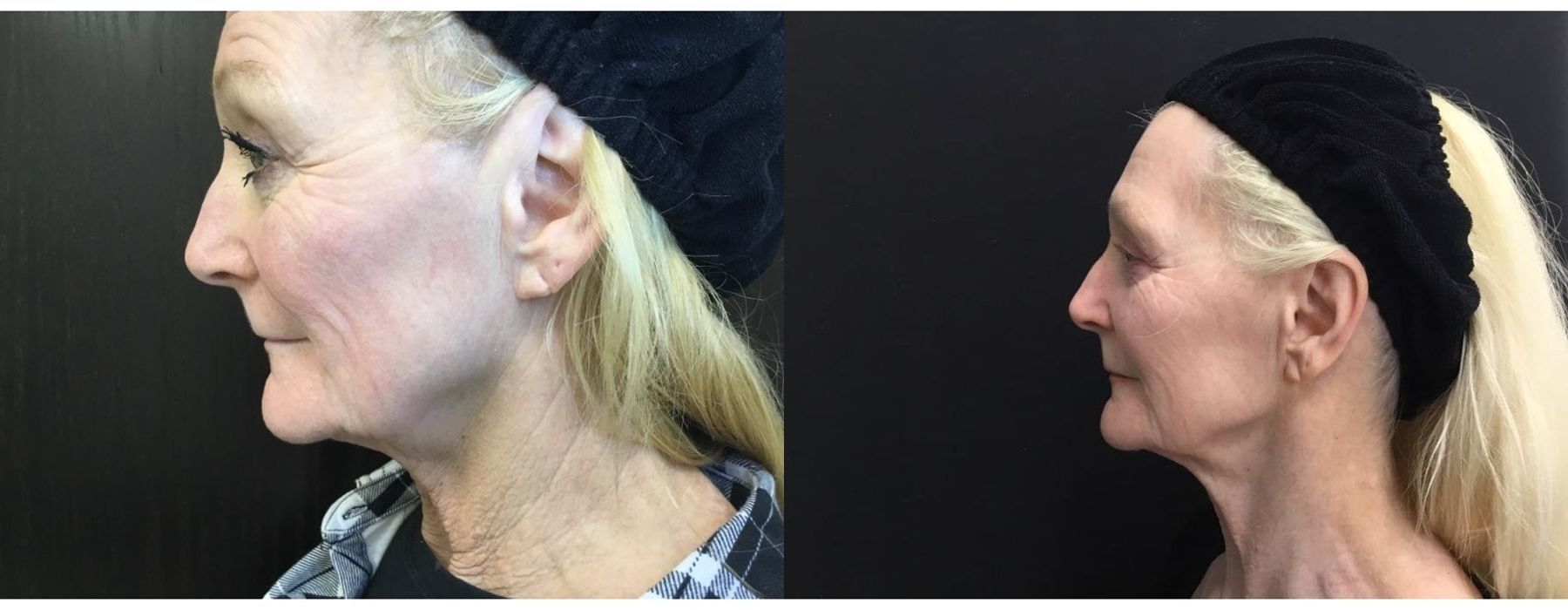 Ultra RF - Case 5344