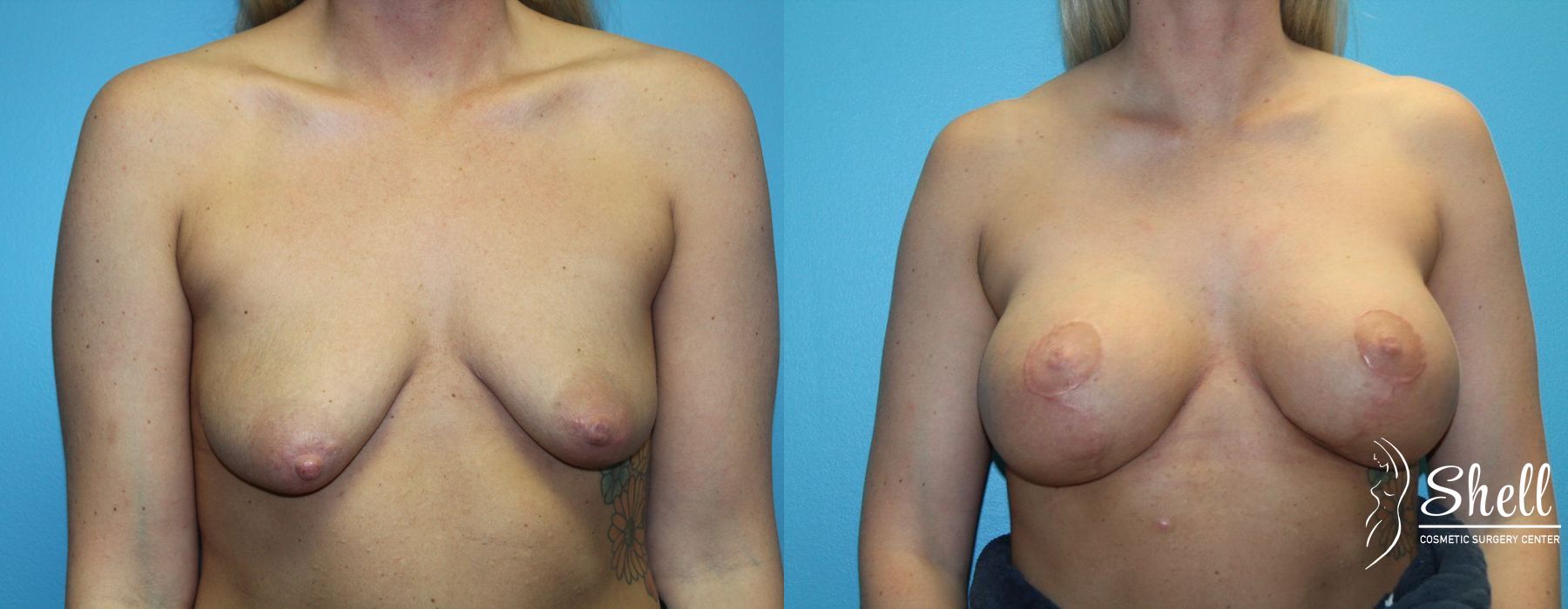 Before and after Breast Augmentation with Lift case 21572