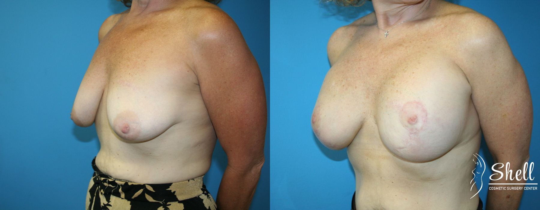 Breast Augmentation with Lift - Thumbnail 2