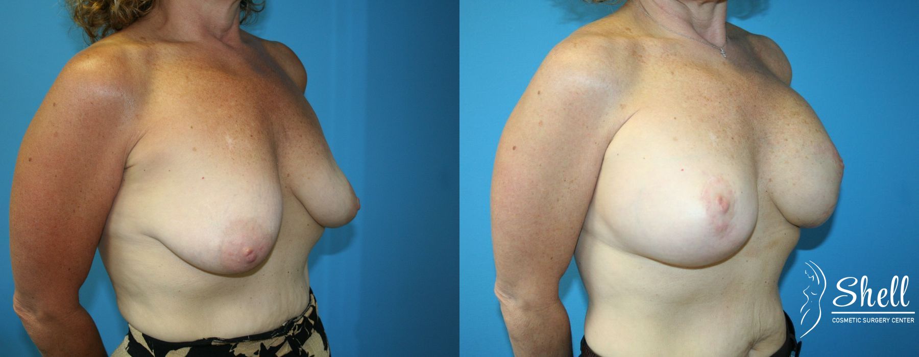 Breast Augmentation with Lift - Thumbnail 4