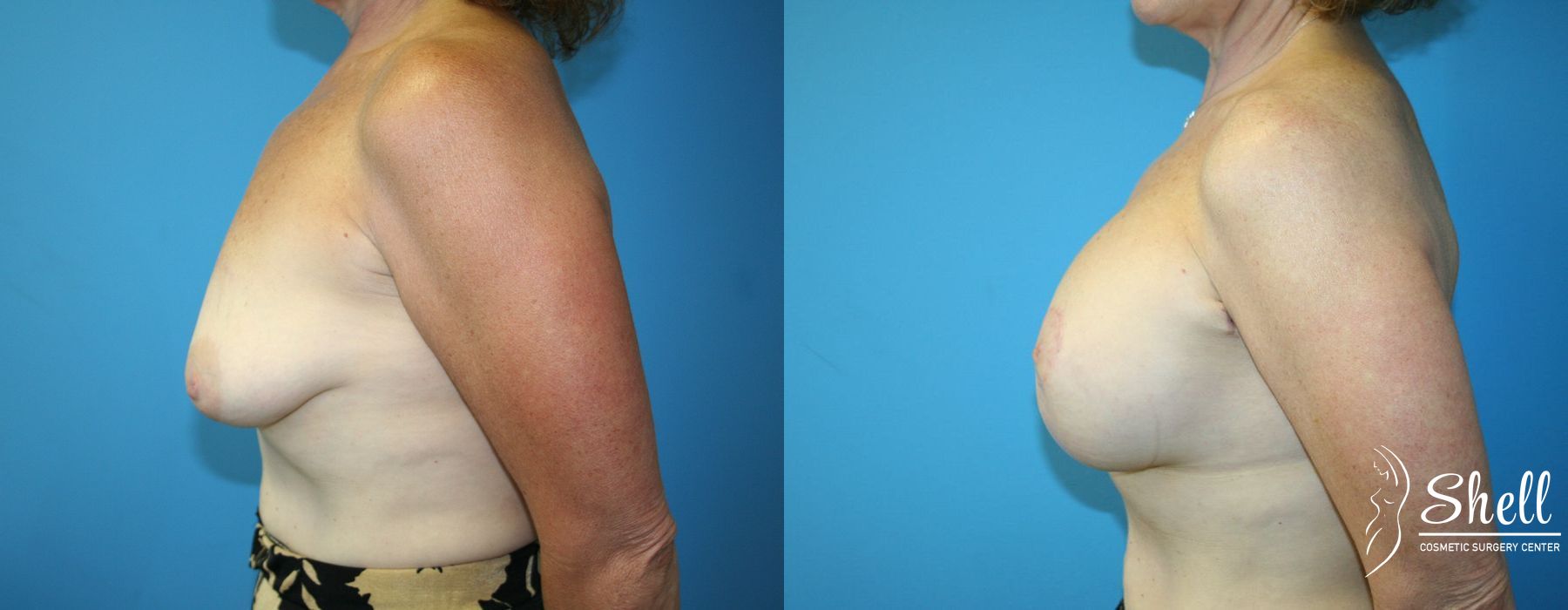 Breast Augmentation with Lift - Thumbnail 3