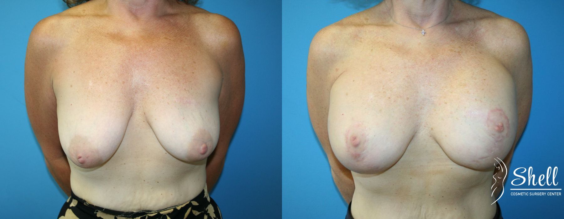 Before and after Breast Augmentation with Lift case 21566