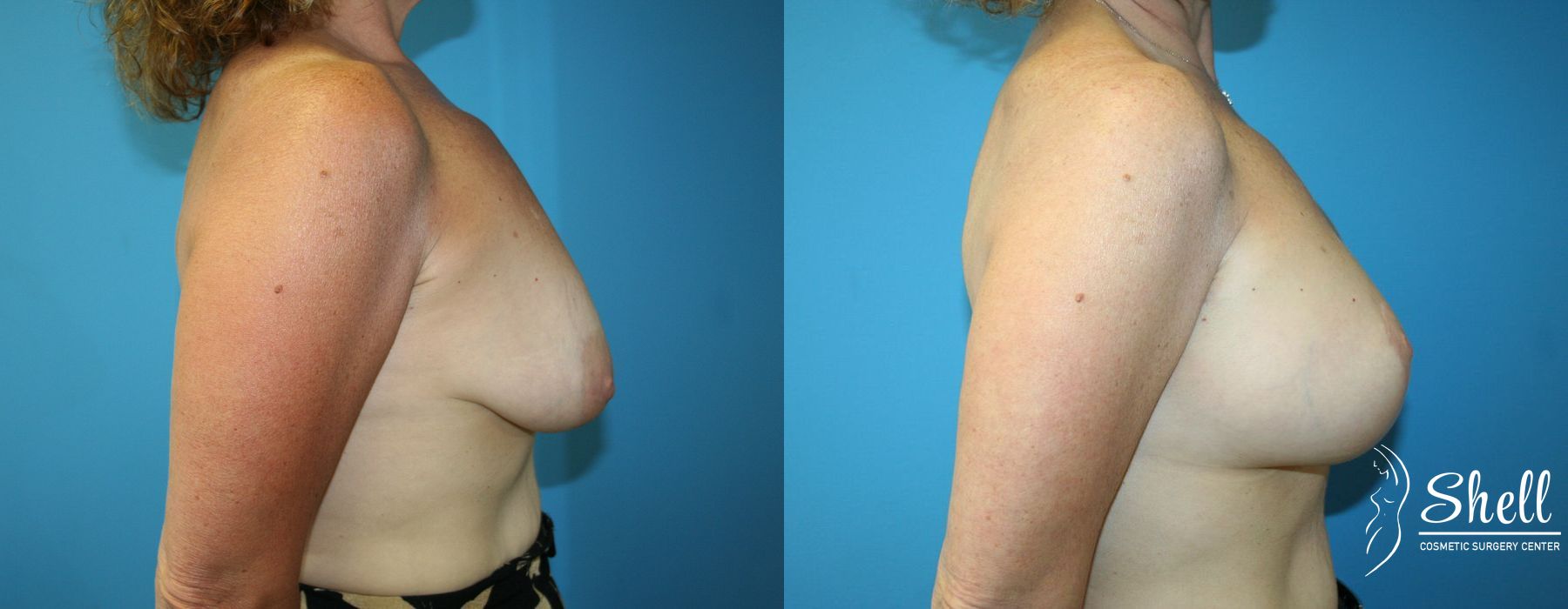 Breast Augmentation with Lift - Thumbnail 5