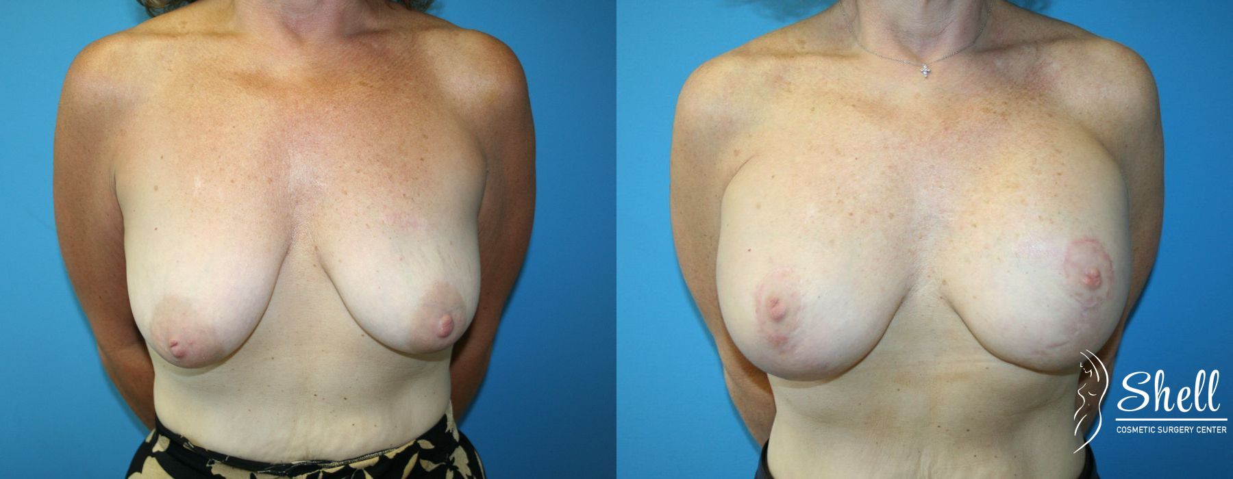 Breast Augmentation with Lift - Case 469