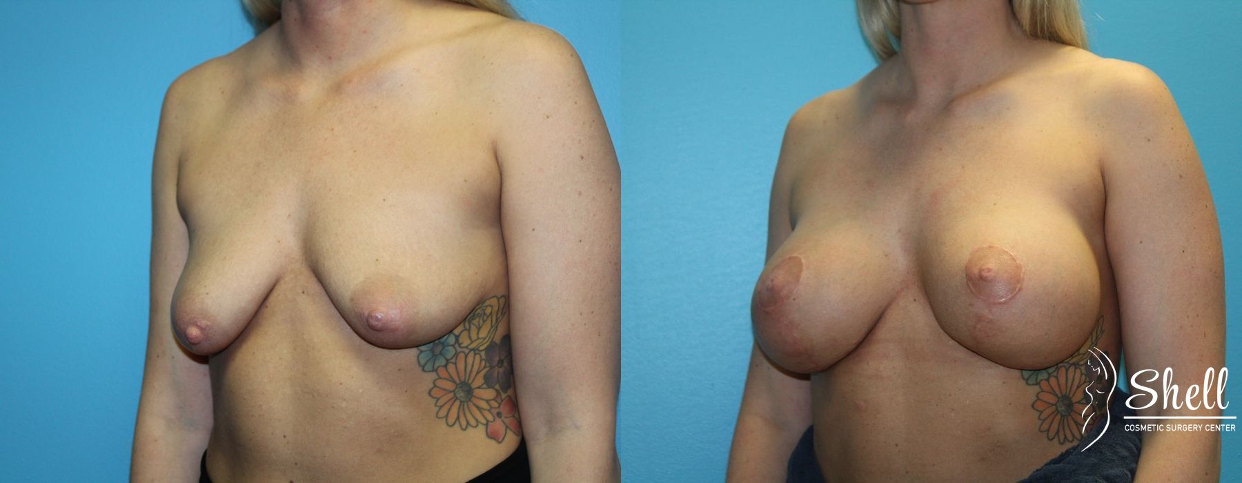 Before and after Breast Augmentation with Lift case 21572 - Angle 2