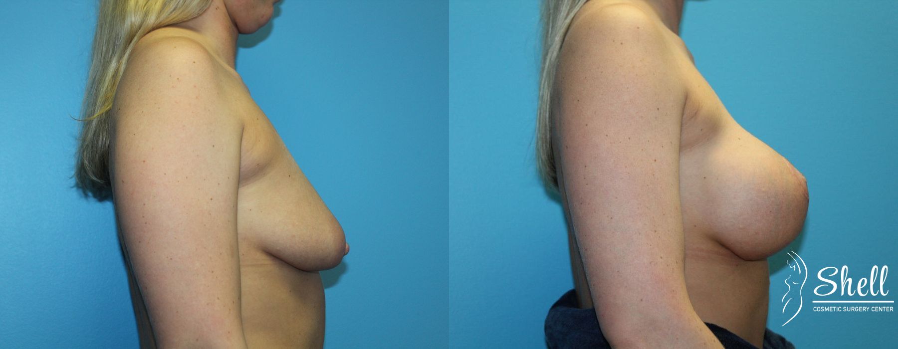Before and after Breast Augmentation with Lift case 21572 - Angle 5