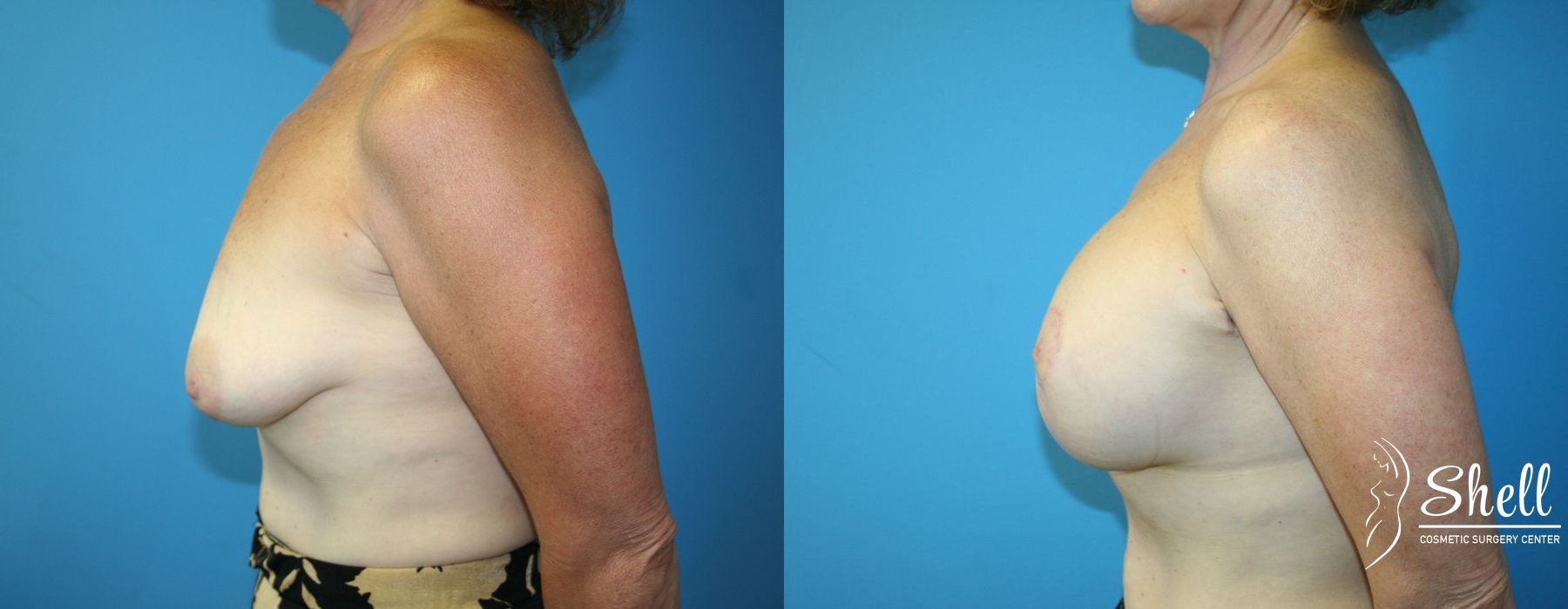 Before and after Breast Augmentation with Lift case 21566 - Angle 3