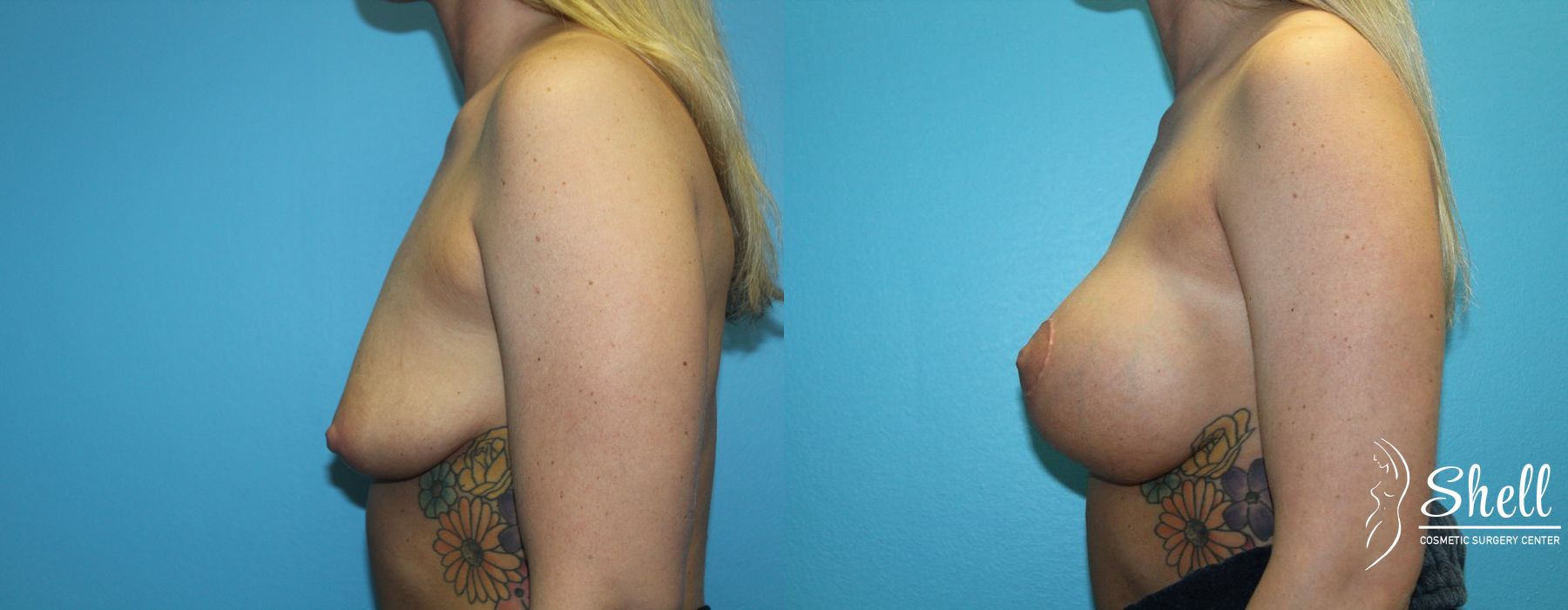 Before and after Breast Augmentation with Lift case 21572 - Angle 3