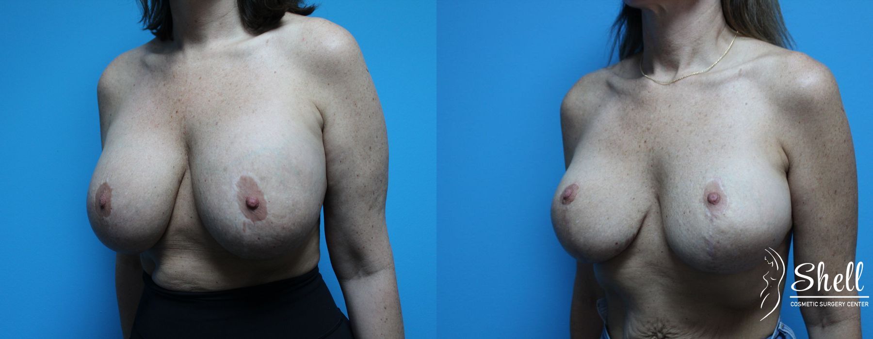 Breast Lift - Thumbnail 2