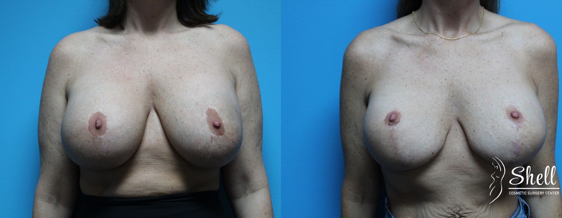 Before and after Breast Lift case 21564