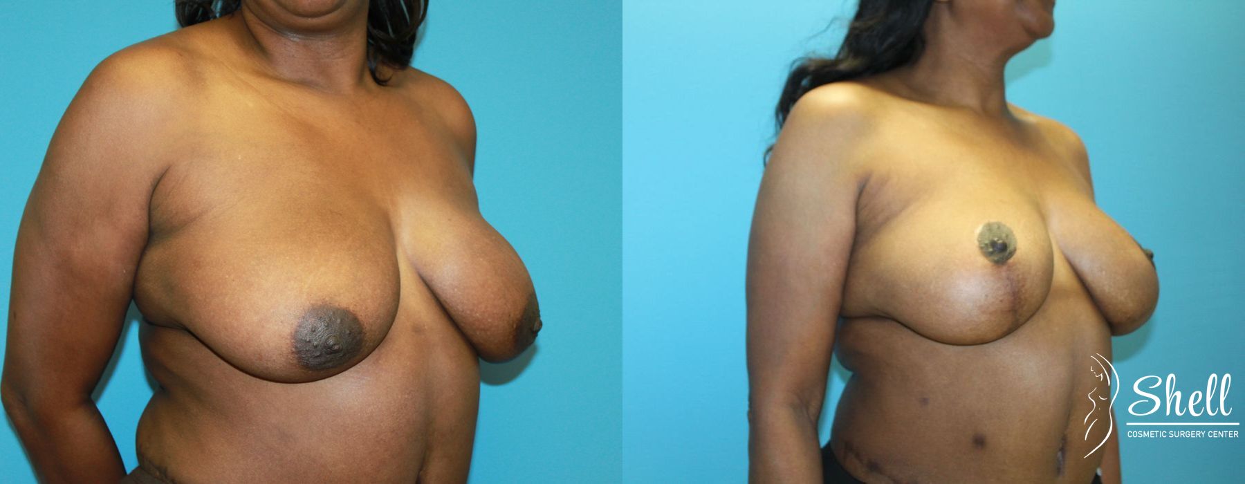 Breast Lift - Thumbnail 4