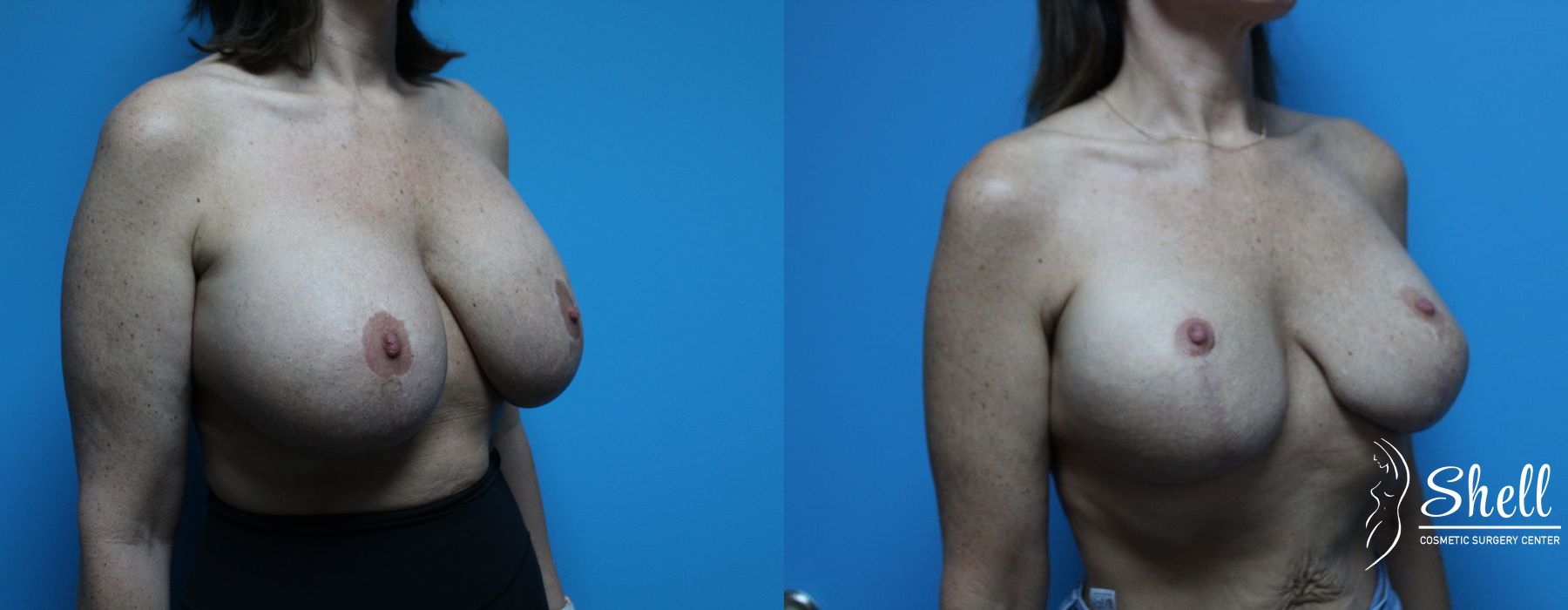 Before and after Breast Lift case 21564 - Angle 4