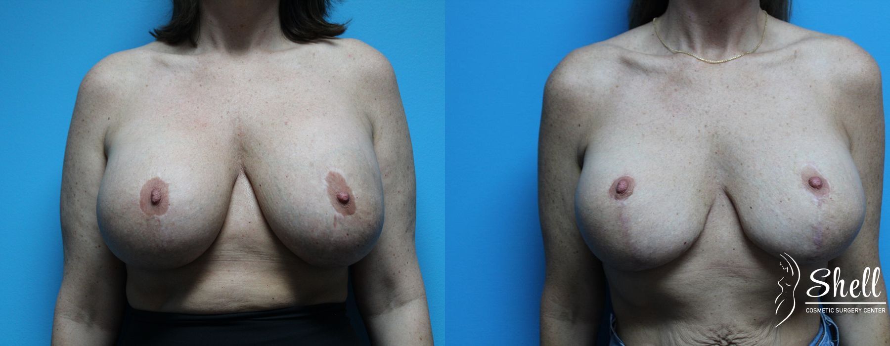 Breast Lift - Case 476