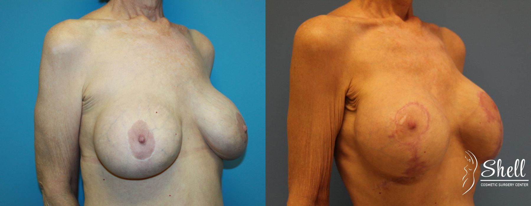 Breast Lift - Thumbnail 4