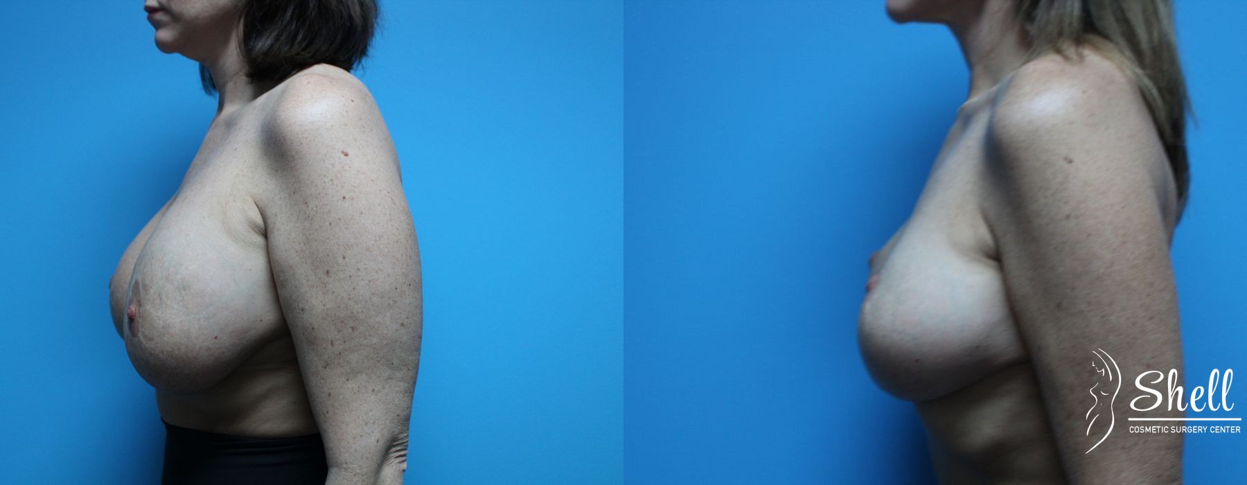 Before and after Breast Lift case 21564 - Angle 3