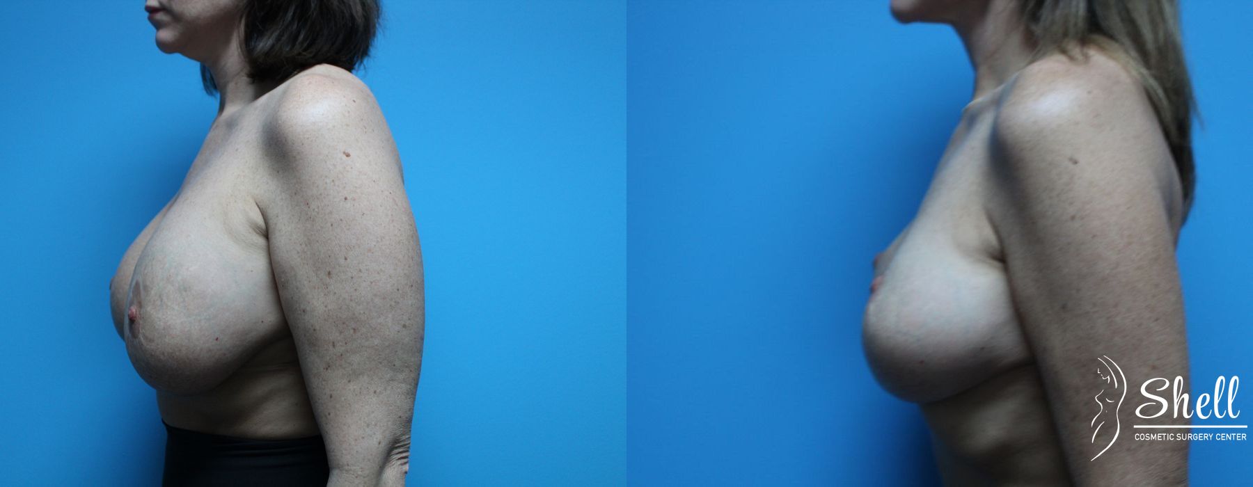 Breast Lift - Thumbnail 3