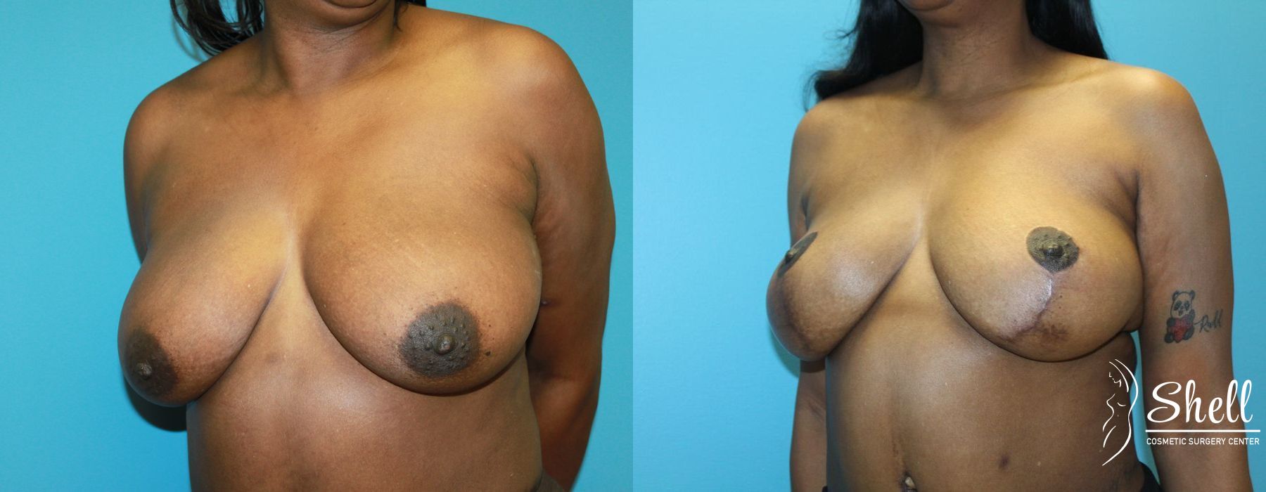 Breast Lift - Thumbnail 2