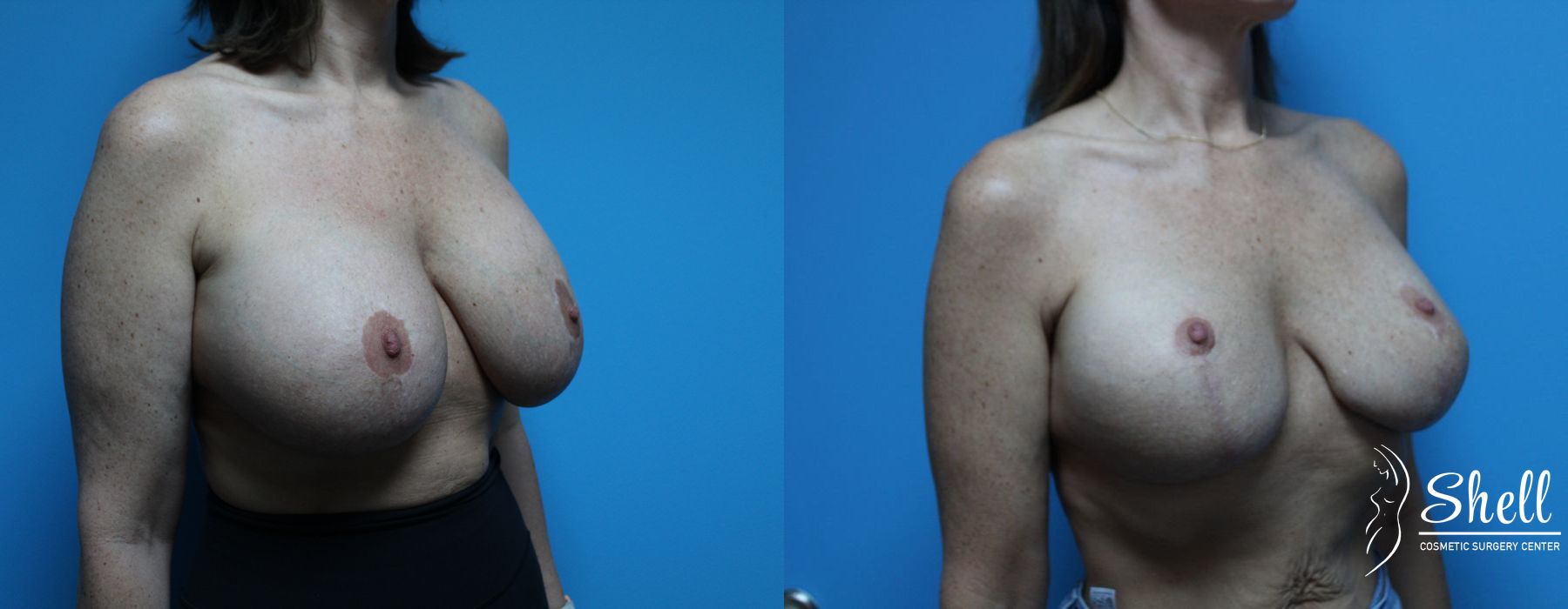Breast Lift - Thumbnail 4