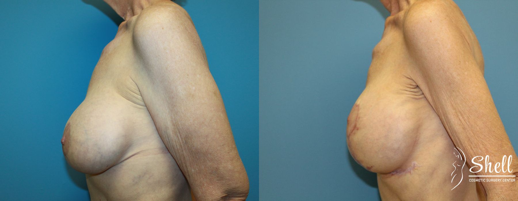 Breast Lift - Thumbnail 3