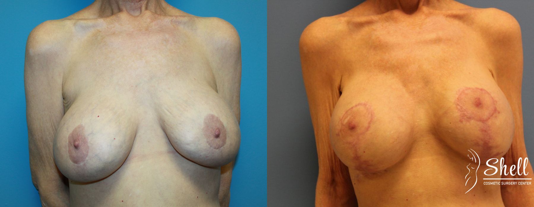 Before and after Breast Lift case 21565