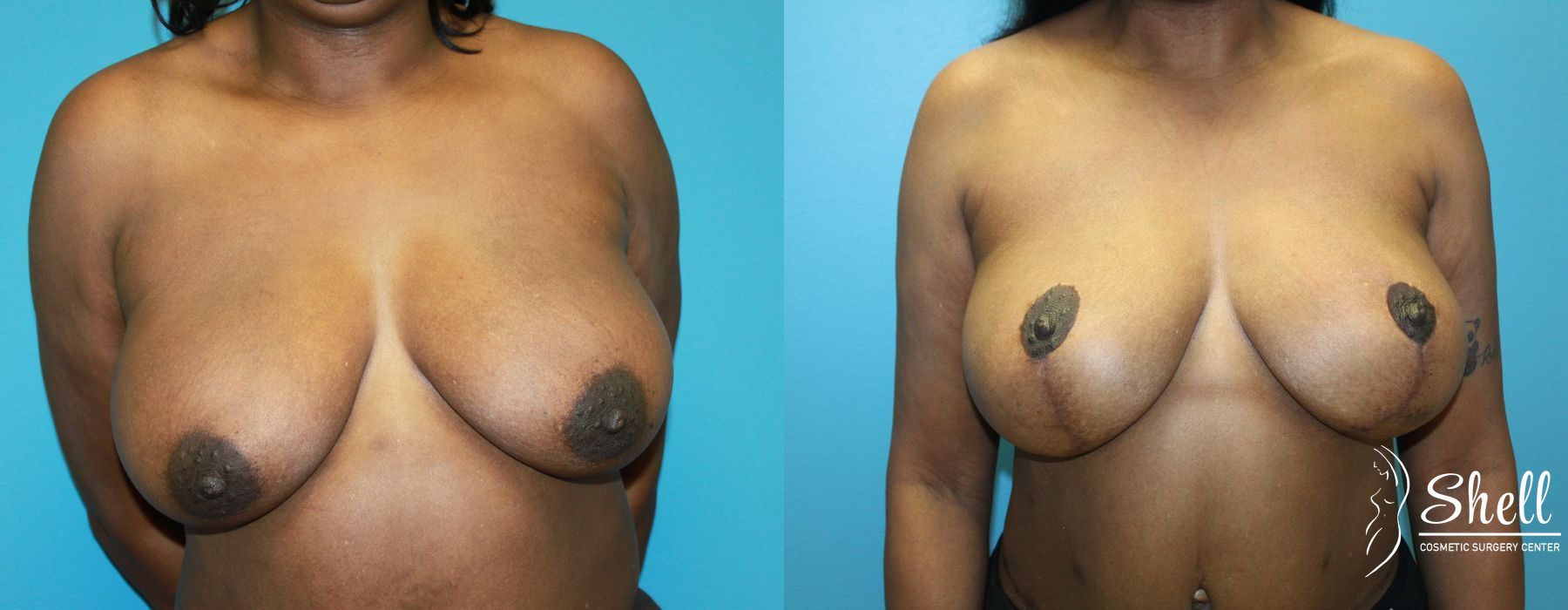 Breast Lift - Case 475