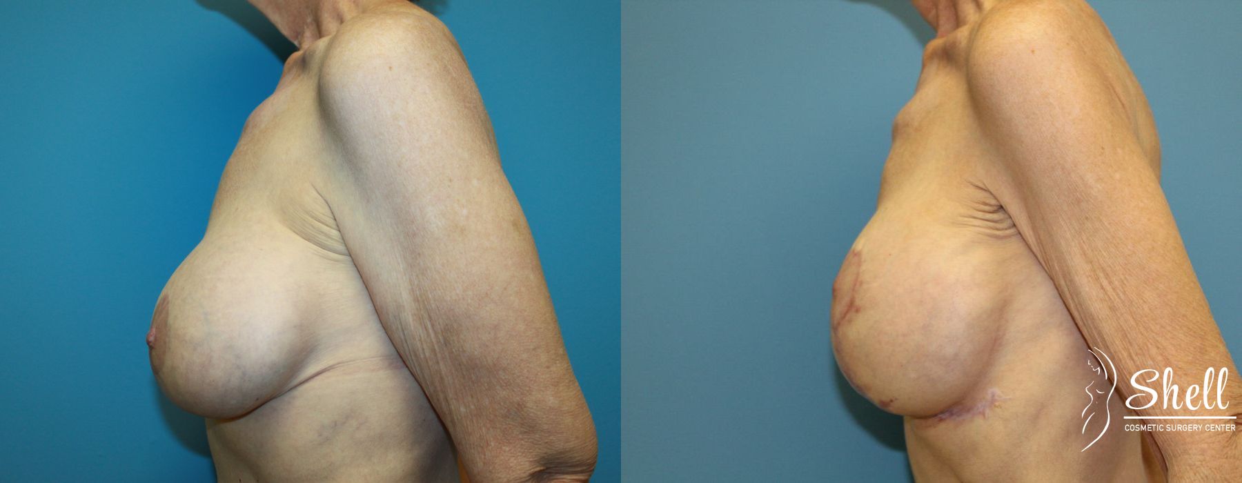 Before and after Breast Lift case 21565 - Angle 3