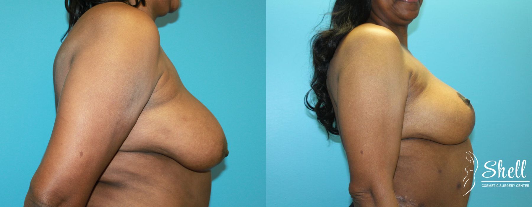 Breast Lift - Thumbnail 5