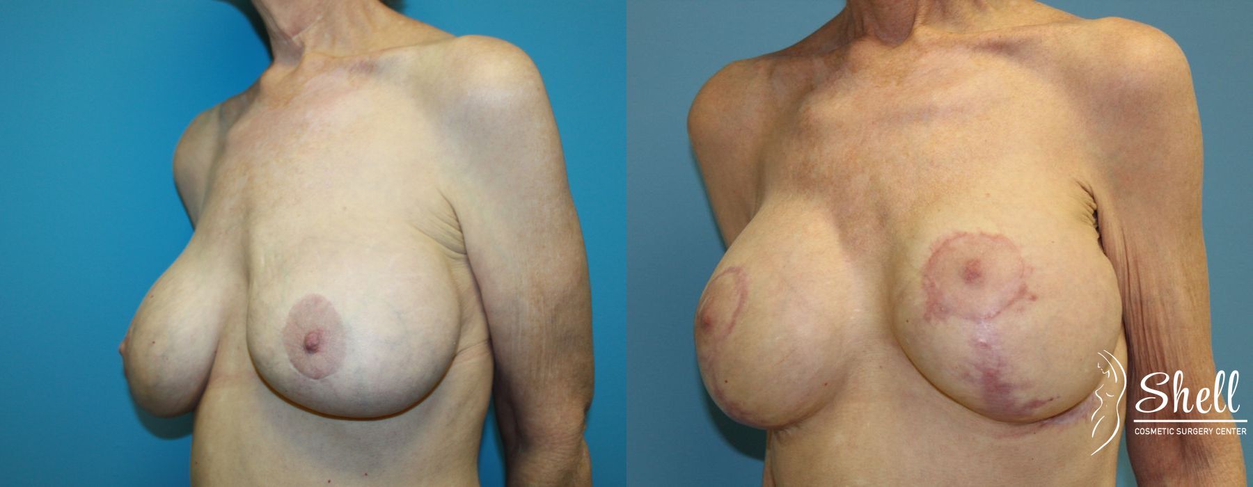 Before and after Breast Lift case 21565 - Angle 2
