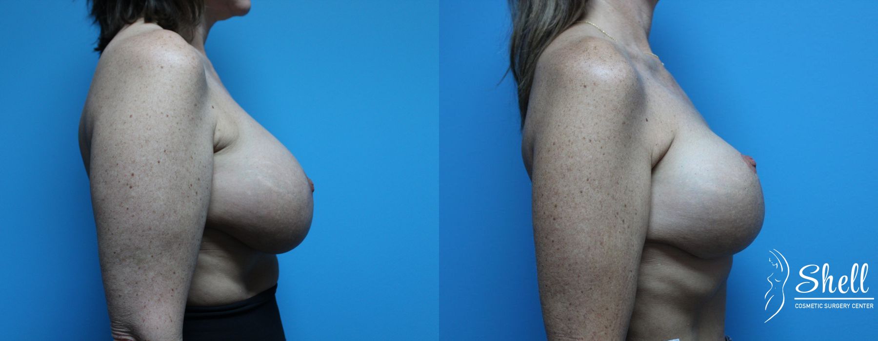 Breast Lift - Thumbnail 5