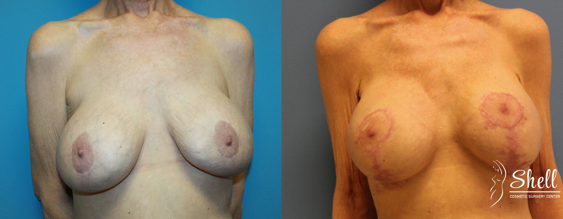 Breast Lift - Case 477