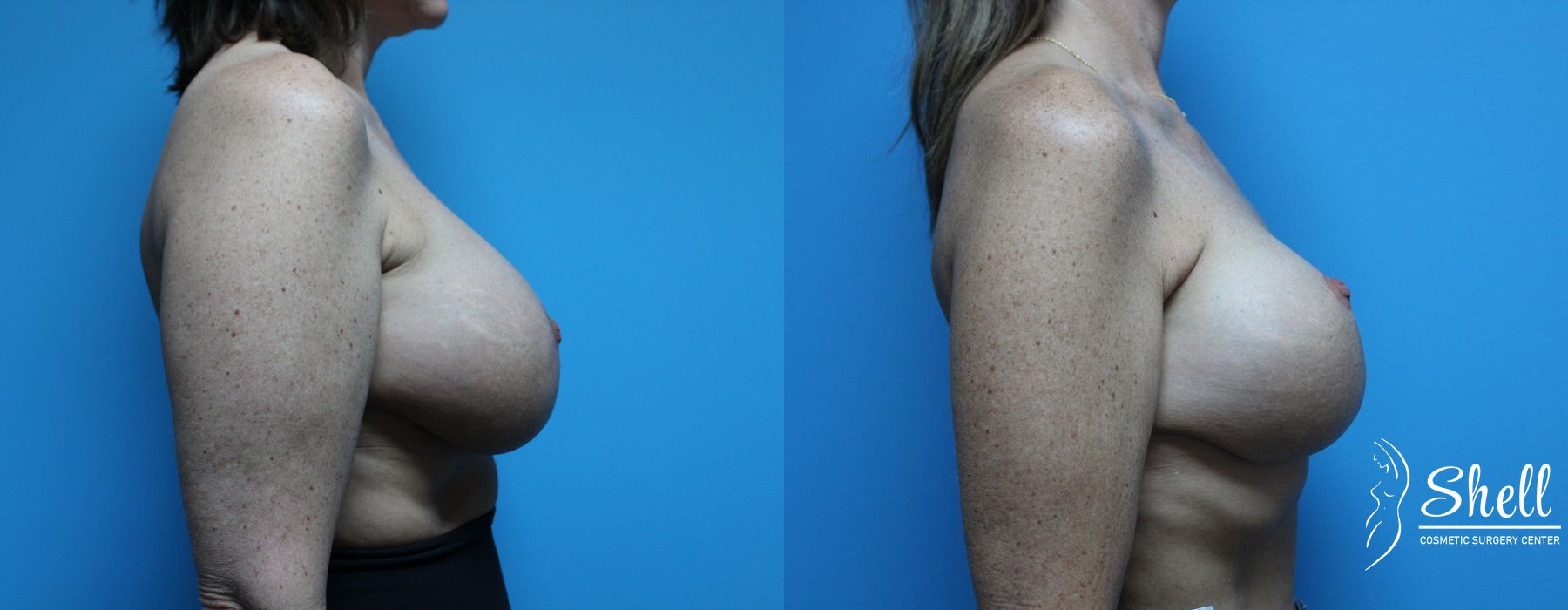 Before and after Breast Lift case 21564 - Angle 5