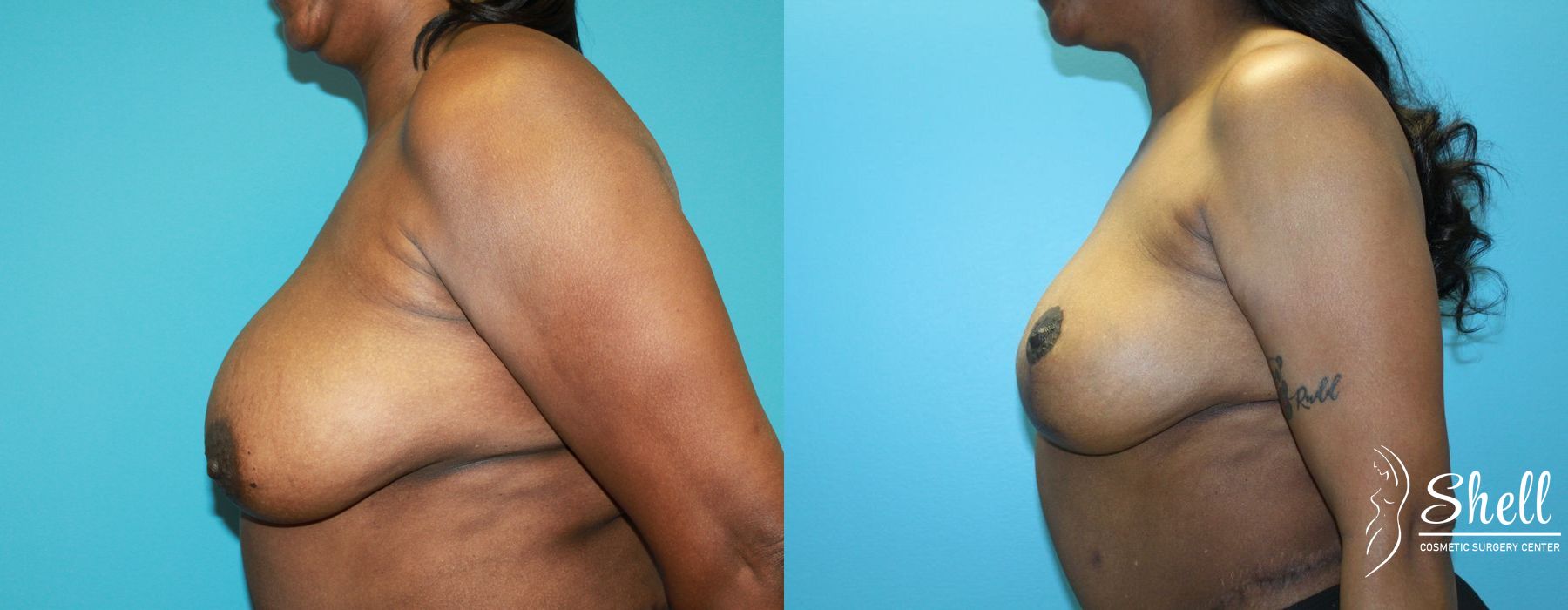 Breast Lift - Thumbnail 3