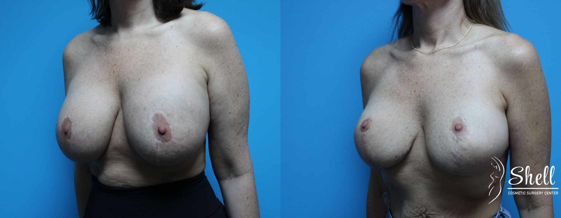 Before and after Breast Lift case 21564 - Angle 2