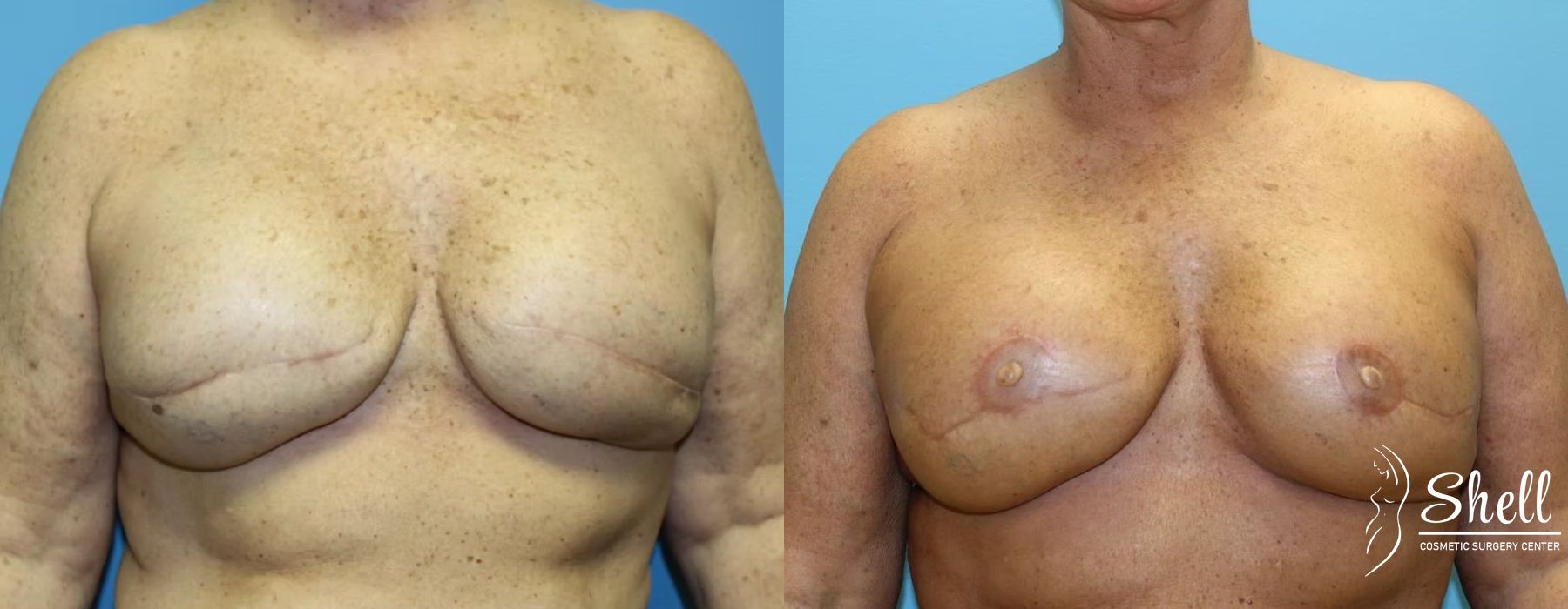 Breast Reconstruction - Case 478