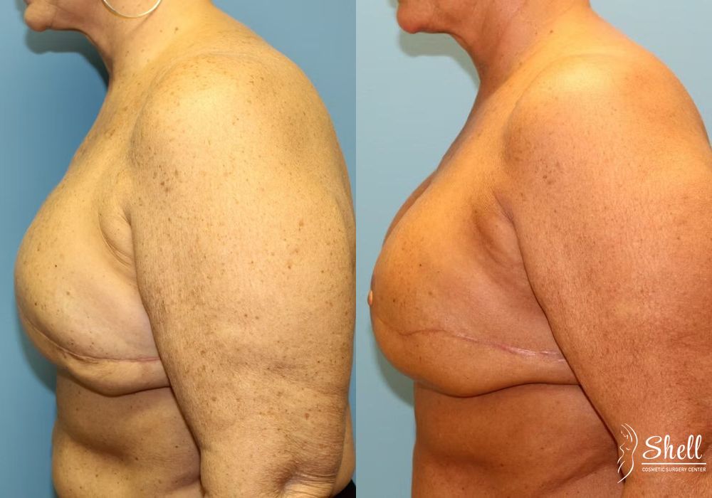 Breast Reconstruction - Thumbnail 2