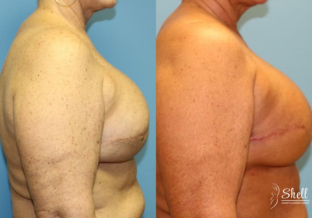 Breast Reconstruction - Thumbnail 2