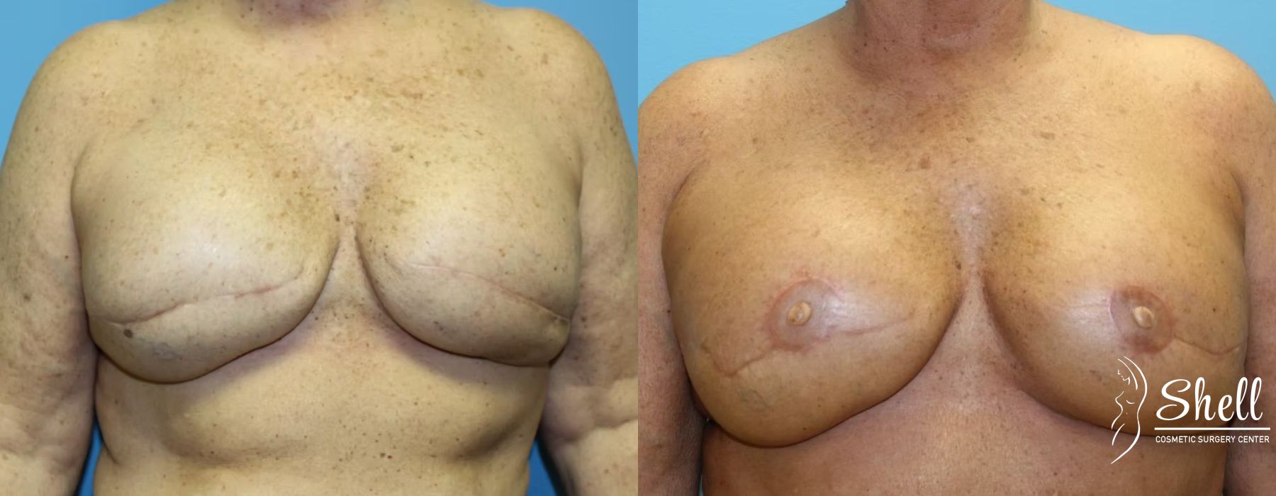 Breast Reconstruction - Case 543