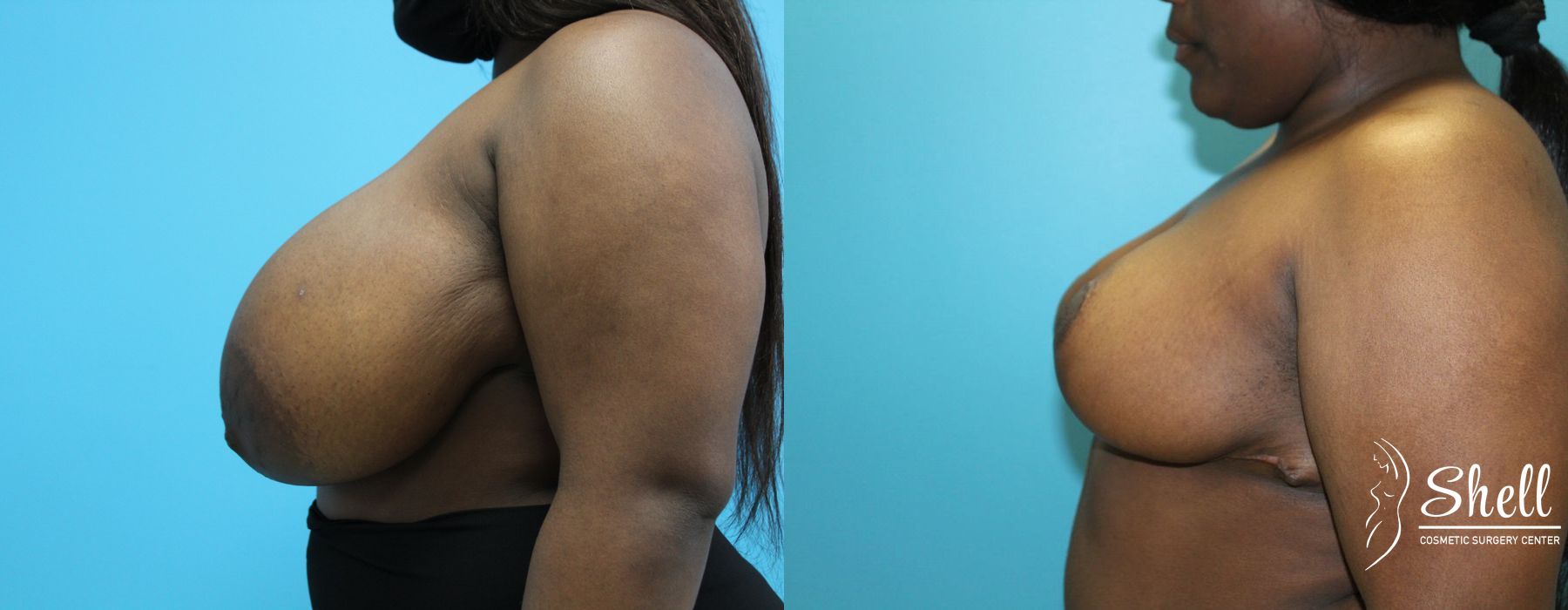 Before and after Breast Reduction case 21573 - Angle 3