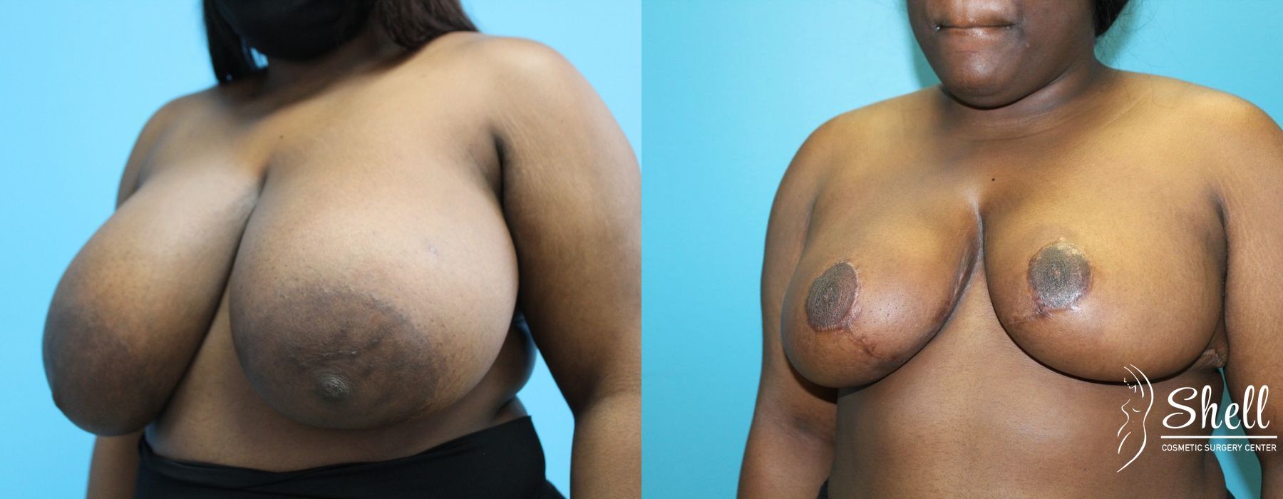 Breast Reduction - Thumbnail 2