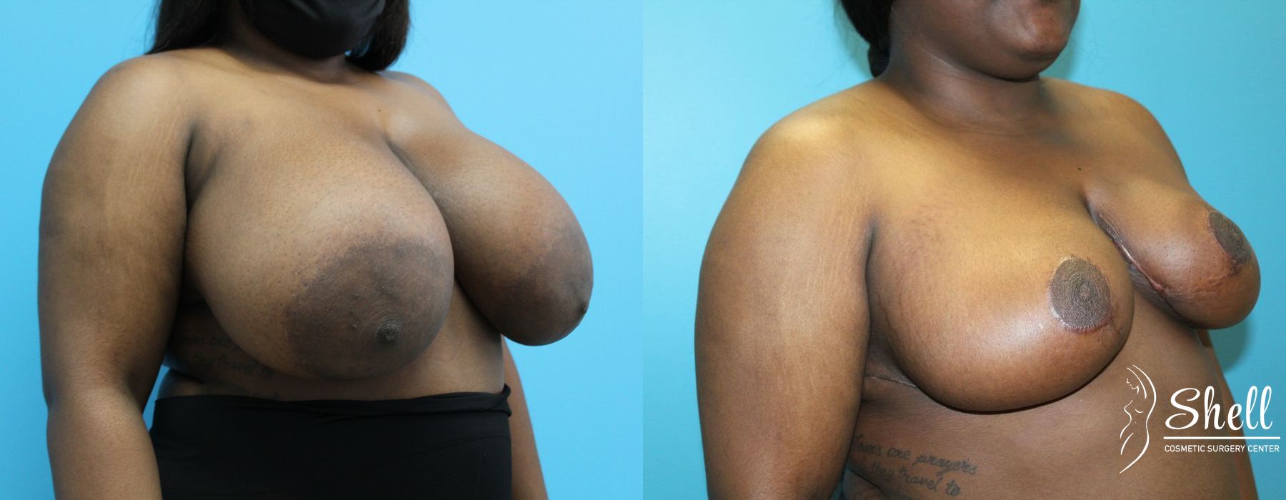 Breast Reduction - Thumbnail 4