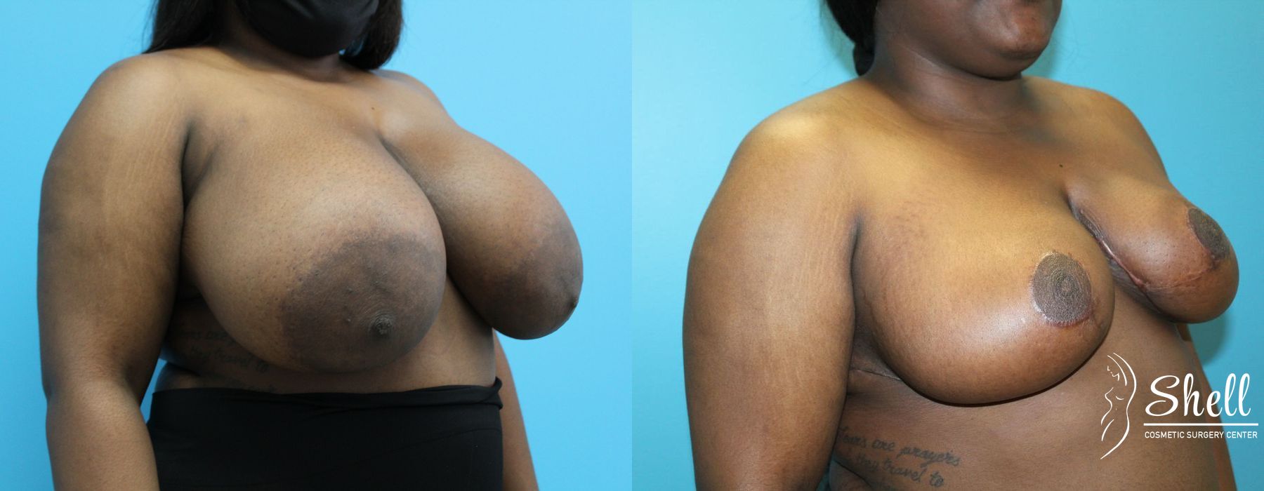 Before and after Breast Reduction case 21573 - Angle 4
