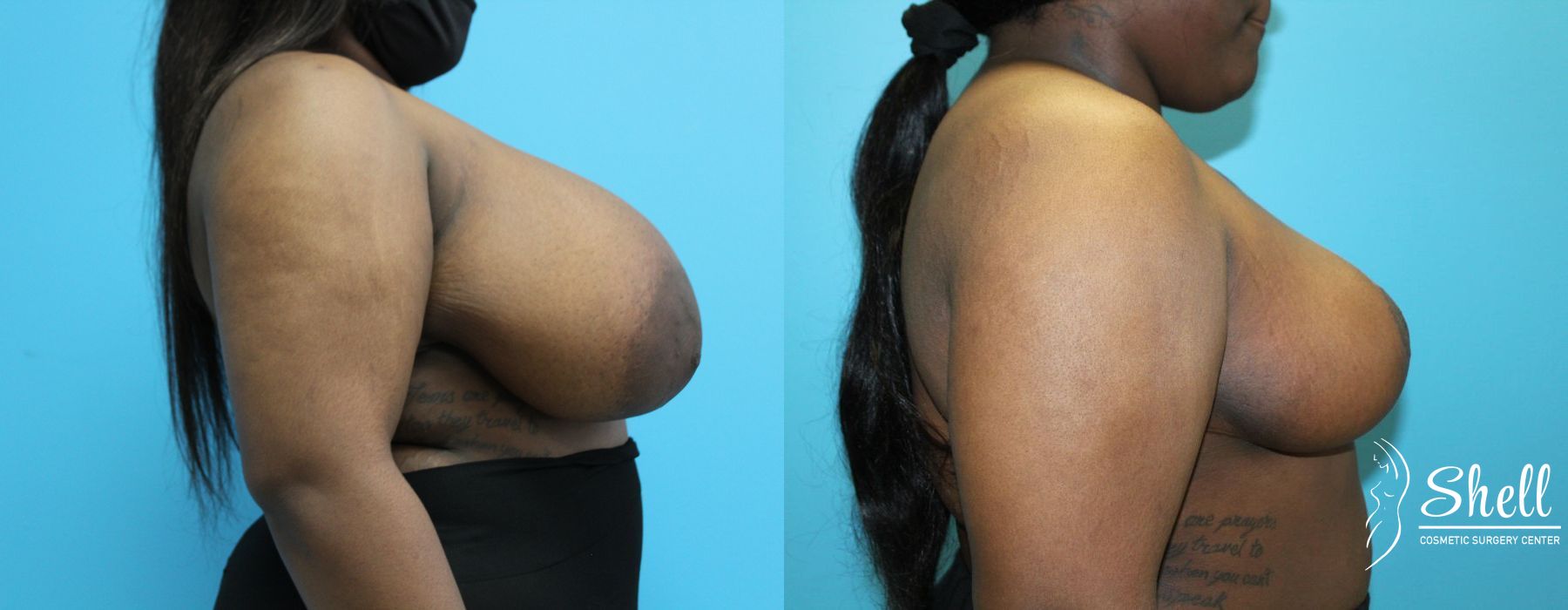 Before and after Breast Reduction case 21573 - Angle 5