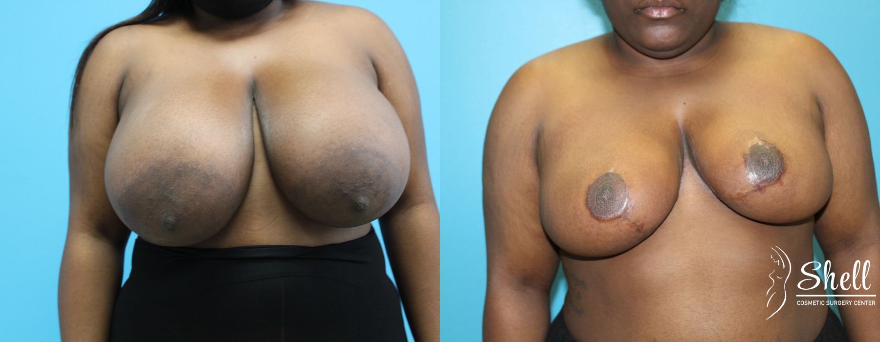 Before and after Breast Reduction case 21573