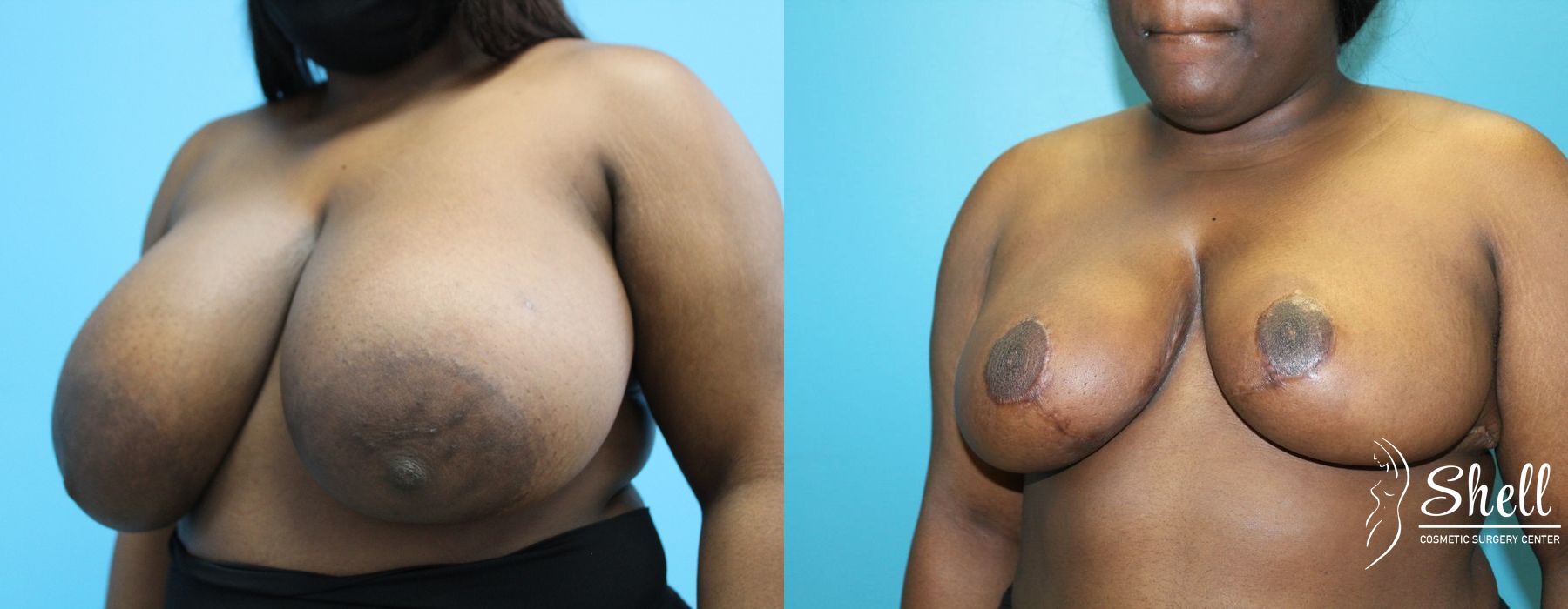 Before and after Breast Reduction case 21573 - Angle 2
