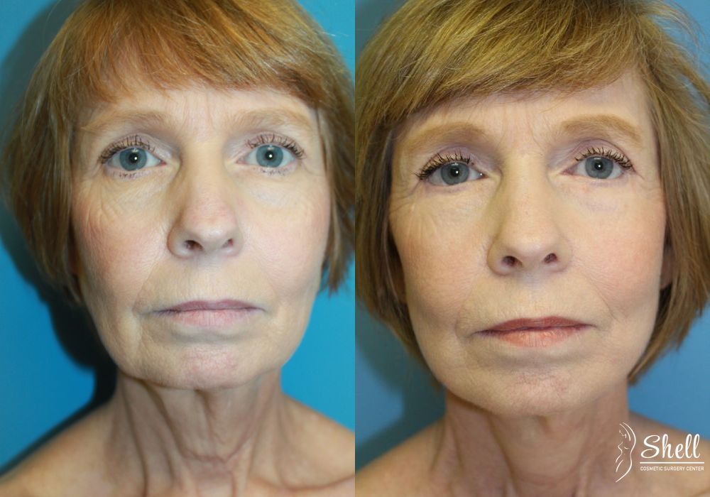 Blepharoplasty - Case 485