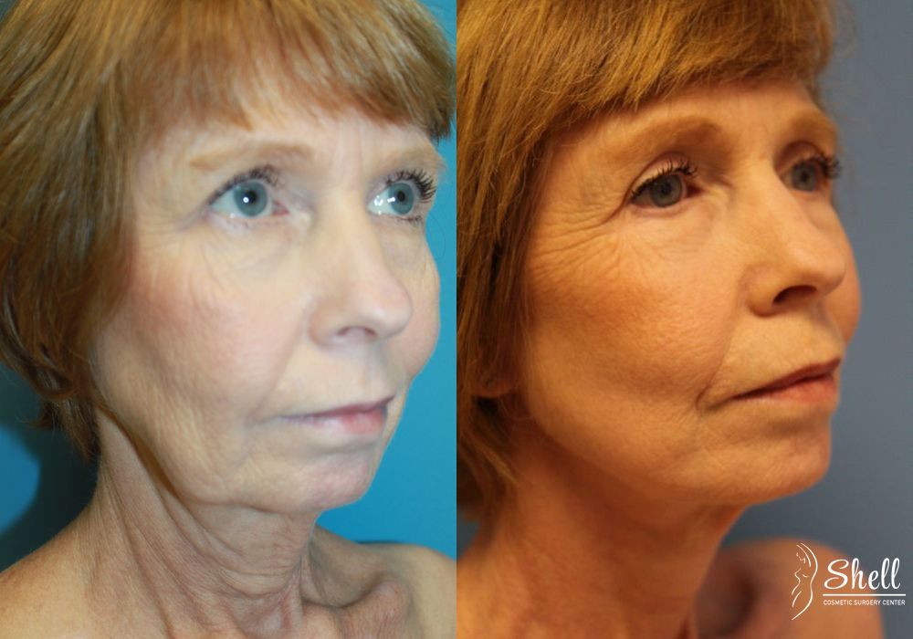 Blepharoplasty - Thumbnail 4