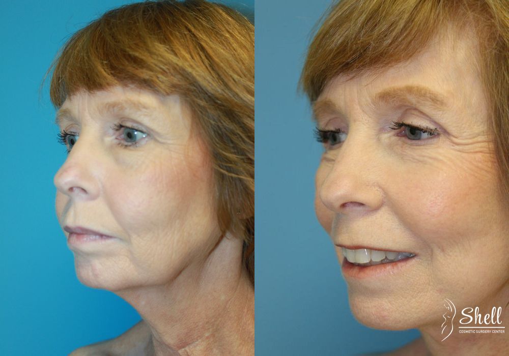 Blepharoplasty - Thumbnail 2