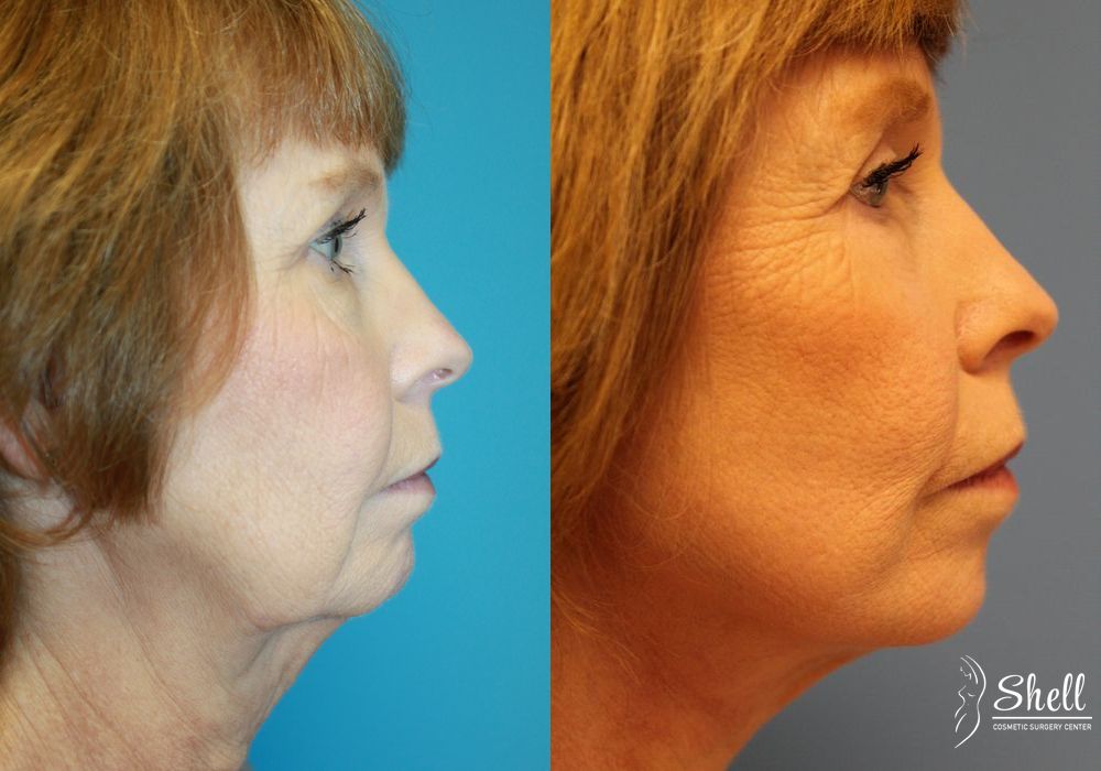 Blepharoplasty - Thumbnail 5