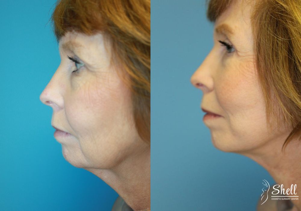 Blepharoplasty - Thumbnail 3