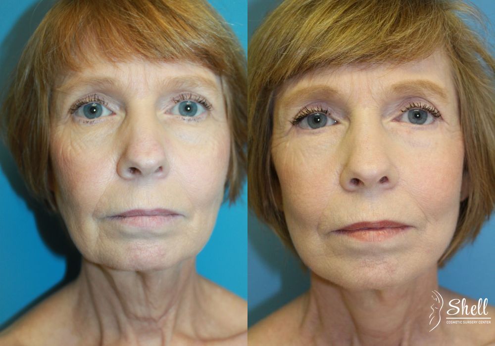 Blepharoplasty - Case 552